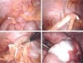 /album/photogallery/iud-found-in-intestine-jpg/