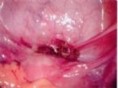 /album/photogallery/tn-laparoscopy2c-jpg/